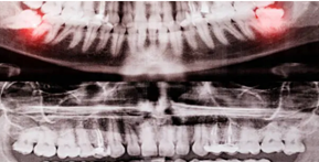wisdom teeth removal Adelaide